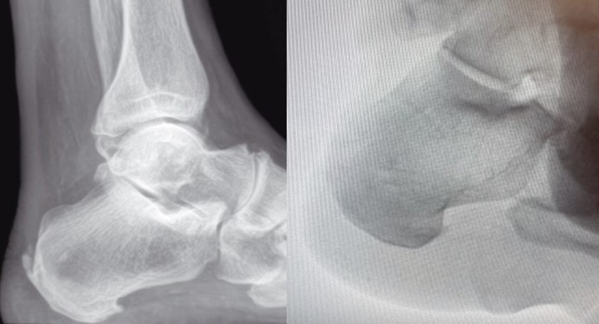 Photo of patient's Achilles pre and post op